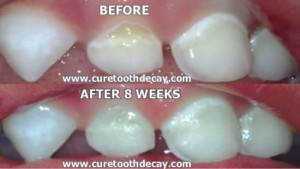 before-tooth-remineralization_mini